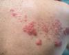 Herpes zoster: diagnoses of the disease are increasing in Brazil