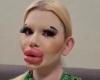 6 surgeries in one day and 30 injections of hyaluronic acid: woman with the biggest lips in the world shocks the web and receives warning from doctors