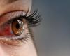 Signs in the eyes may indicate high blood pressure; understand