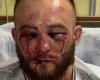 Polish man shows disfigured face after defeat